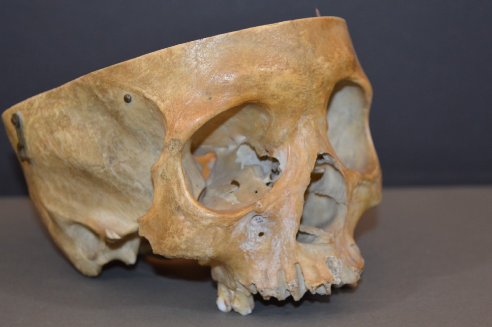 Medical School Human Skull, c1890