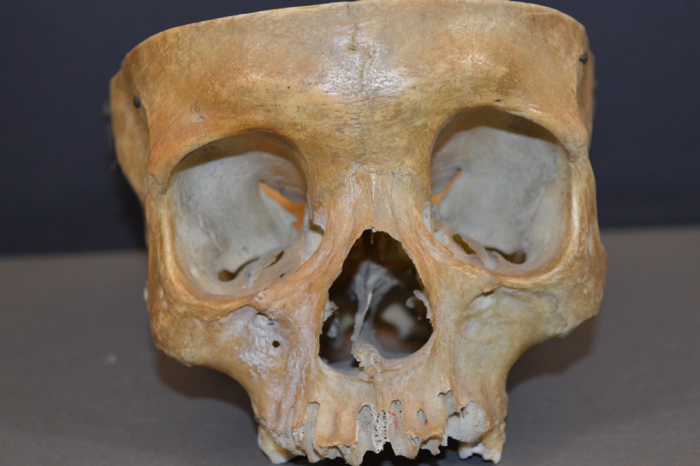 Medical School Human Skull, c1890 View II