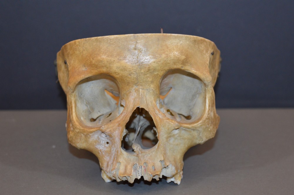 Medical School Human Skull, c1890 View III