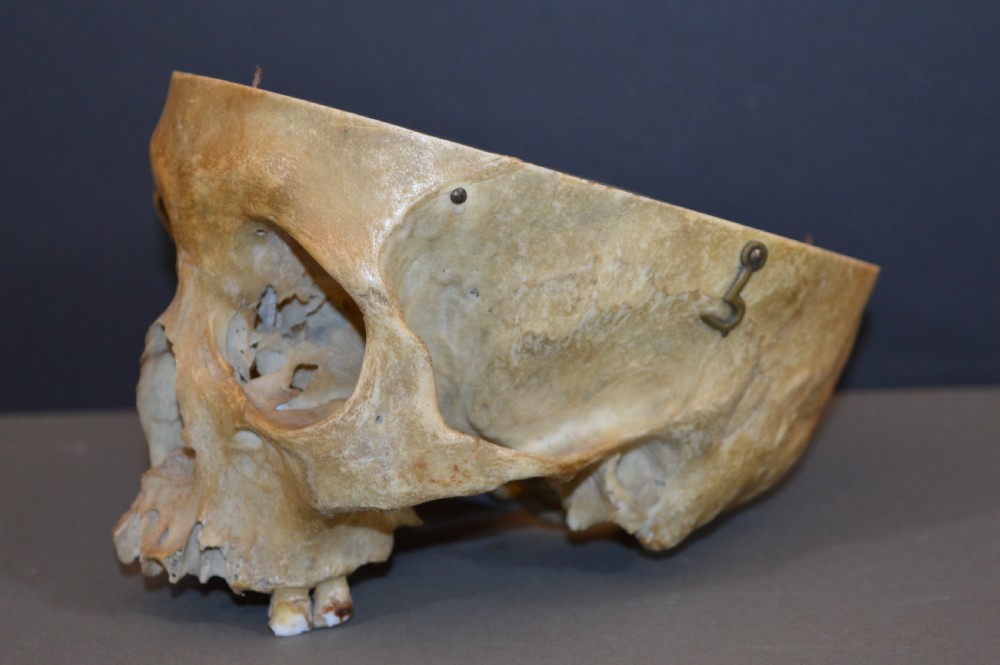 Medical School Human Skull, c1890 View IV