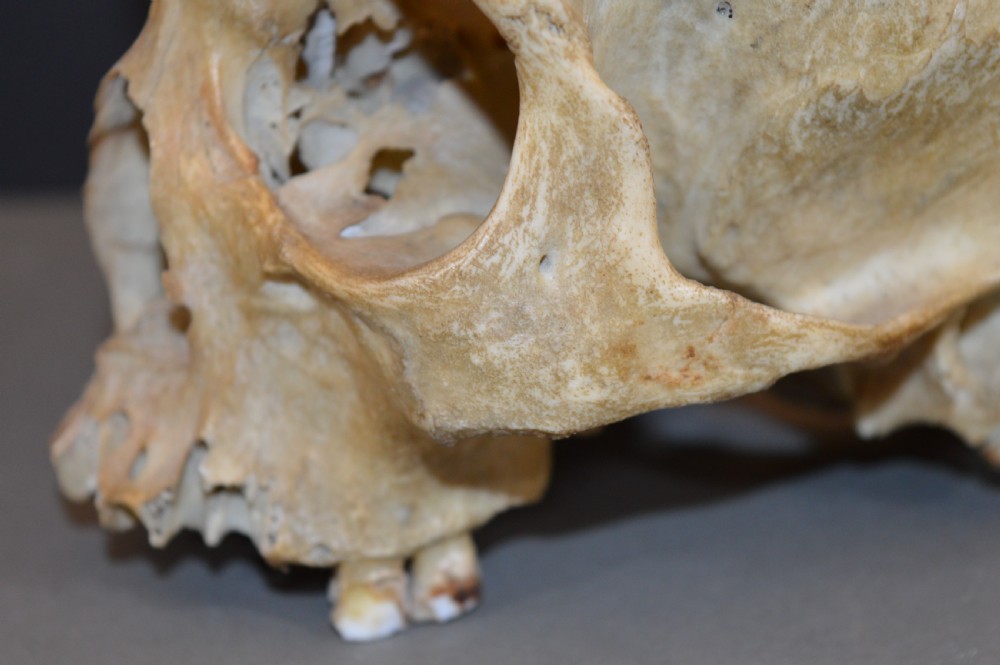 Medical School Human Skull, c1890 View V