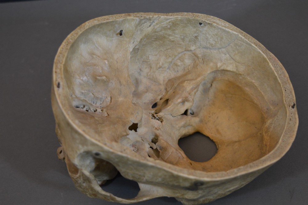 Medical School Human Skull, c1890 View VI