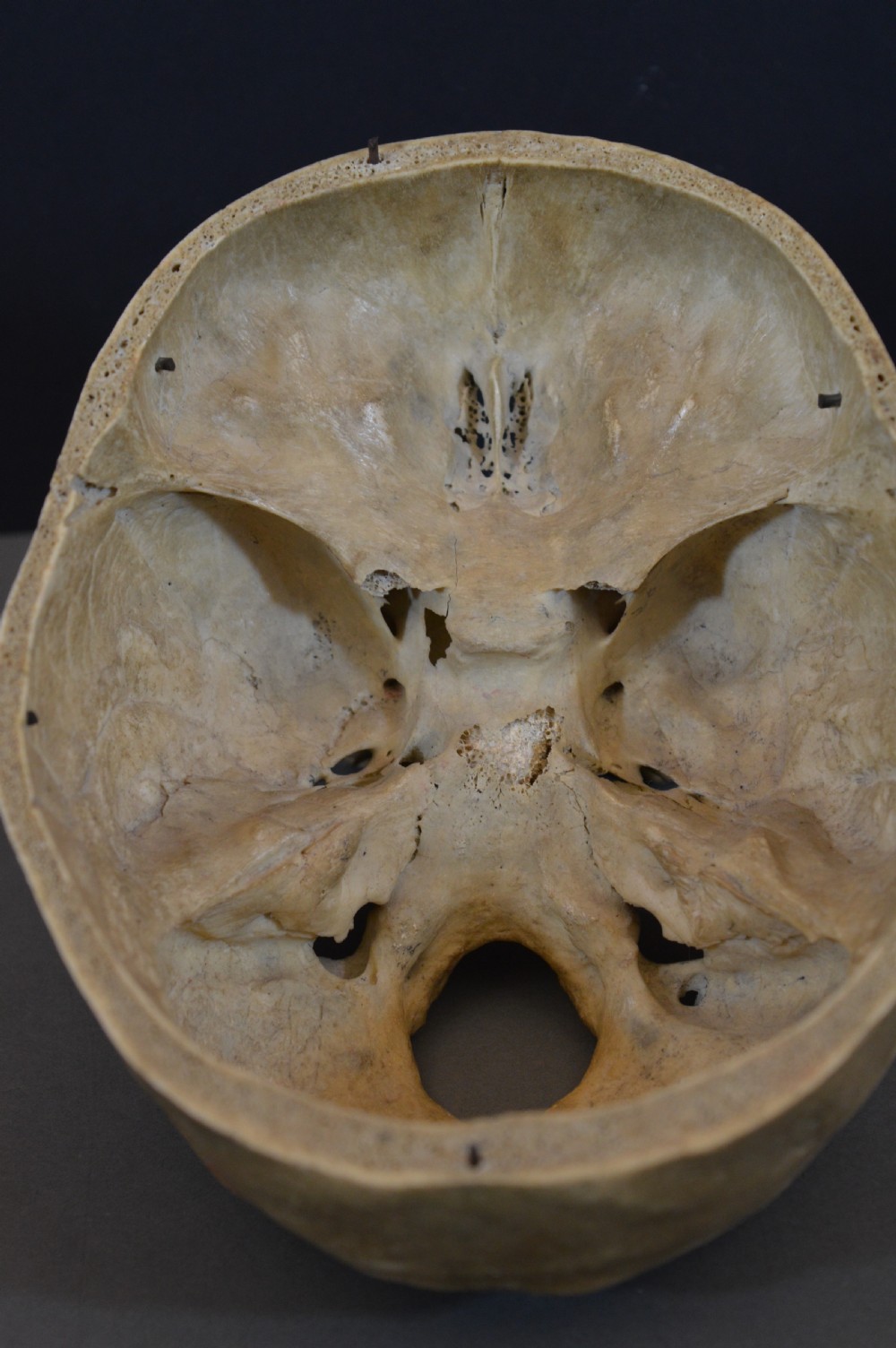 Medical School Human Skull, c1890 View VII