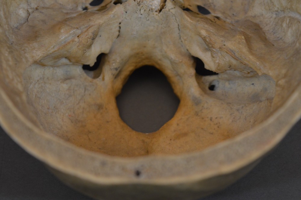 Medical School Human Skull, c1890 View VIII