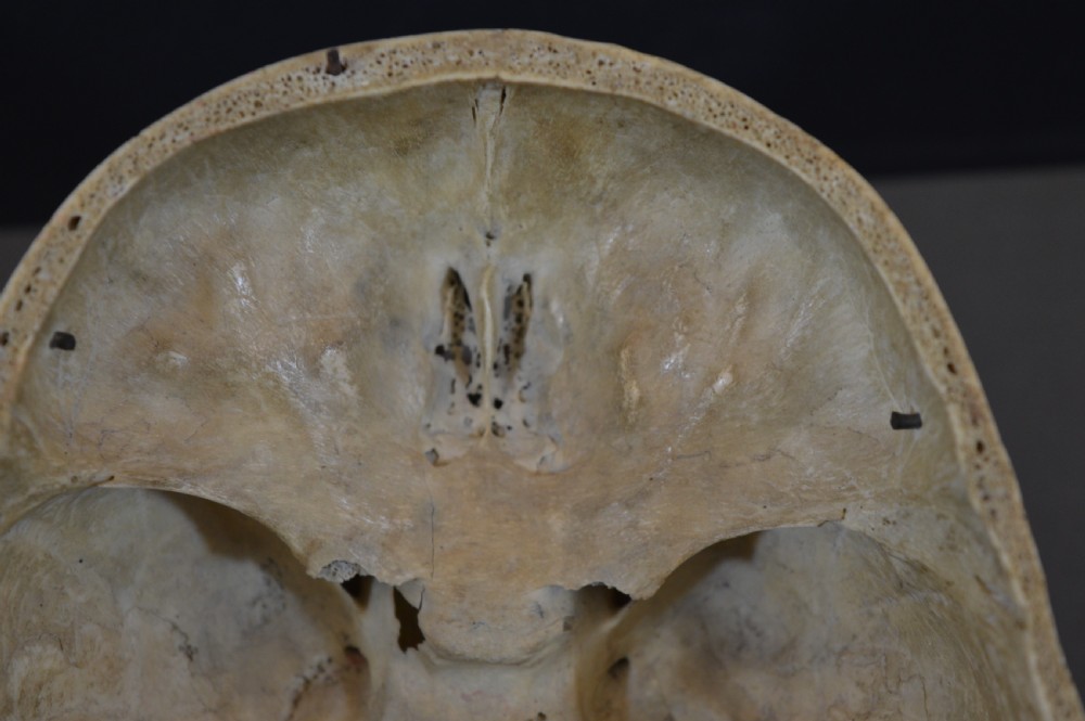 Medical School Human Skull, c1890 View IX