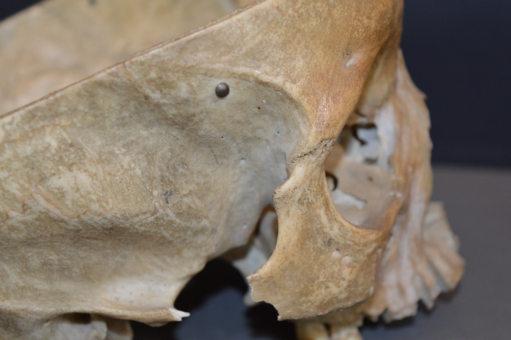Medical School Human Skull, c1890 View X