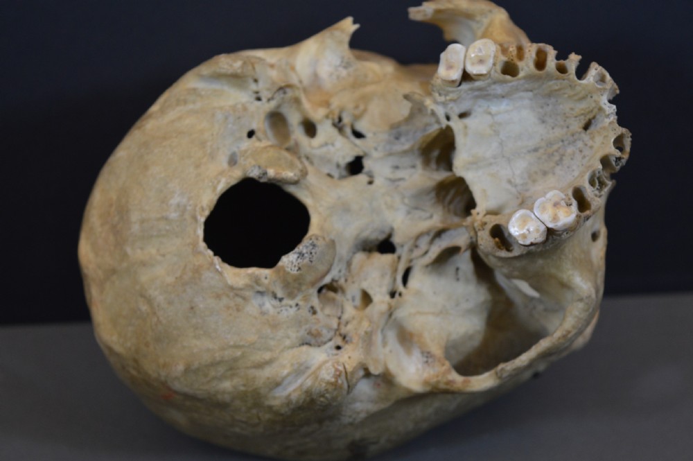 Medical School Human Skull, c1890 View XI
