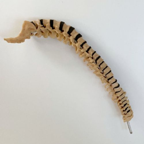 fig 1. Scoliosis Spinal Column Model by Educational & Scientific Plastics Ltd