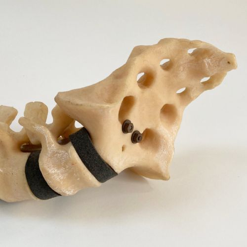 fig 2. Scoliosis Spinal Column Model by Educational & Scientific Plastics Ltd
