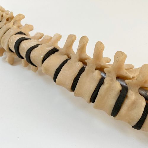 fig 4. Scoliosis Spinal Column Model by Educational & Scientific Plastics Ltd