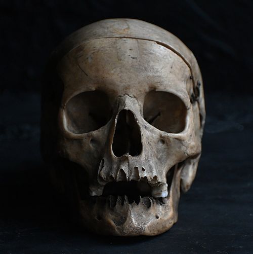fig 1. Front view of a 19th-century human anatomical skull specimen featuring a cut cranium top secured with metal wire closures.