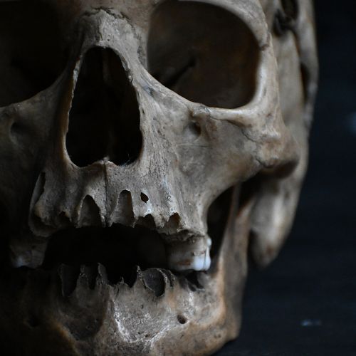 fig 2. Front view of a 19th-century human anatomical skull specimen featuring a cut cranium top secured with metal wire closures.
