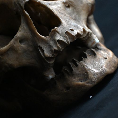 fig 3. Front view of a 19th-century human anatomical skull specimen featuring a cut cranium top secured with metal wire closures.