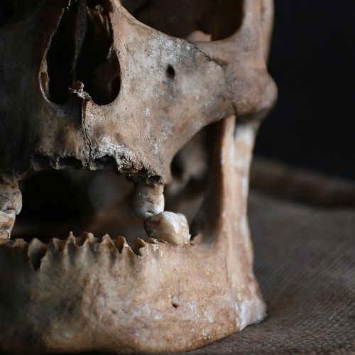 fig 1. A profile view of a nineteenth-century human skull showing the cranium, eye orbit, jaw, and intact teeth against a plain background.