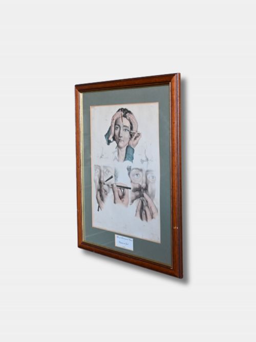 C 1850 FRAMED HANDCOLOURED LITHOGRAPH MEDICAL PROCEDURES FRENCH - ADDITIONAL PHOTO 1