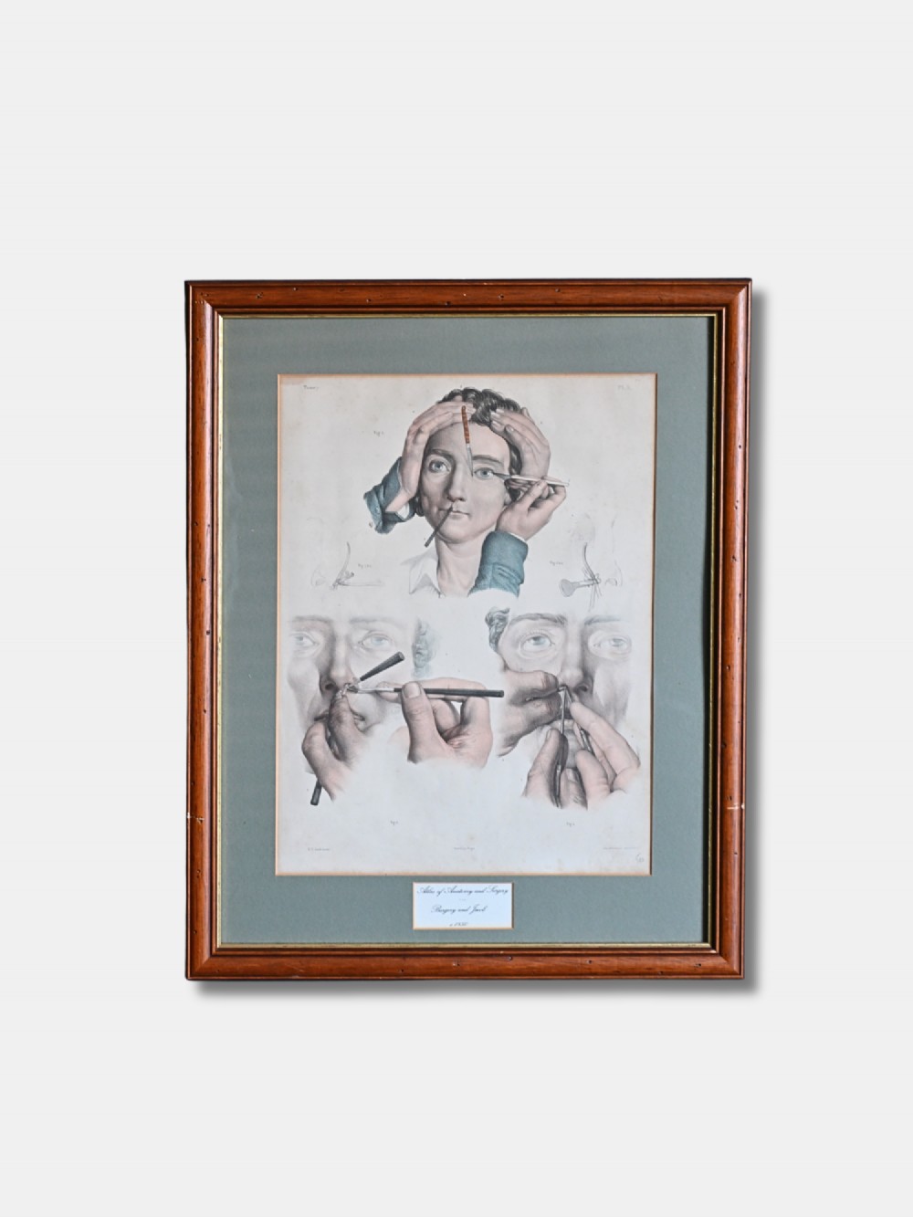 A framed 19th-century hand-coloured lithograph displaying three detailed surgical procedures on the human face, presented within a sage green mount and a warm brown wood frame.