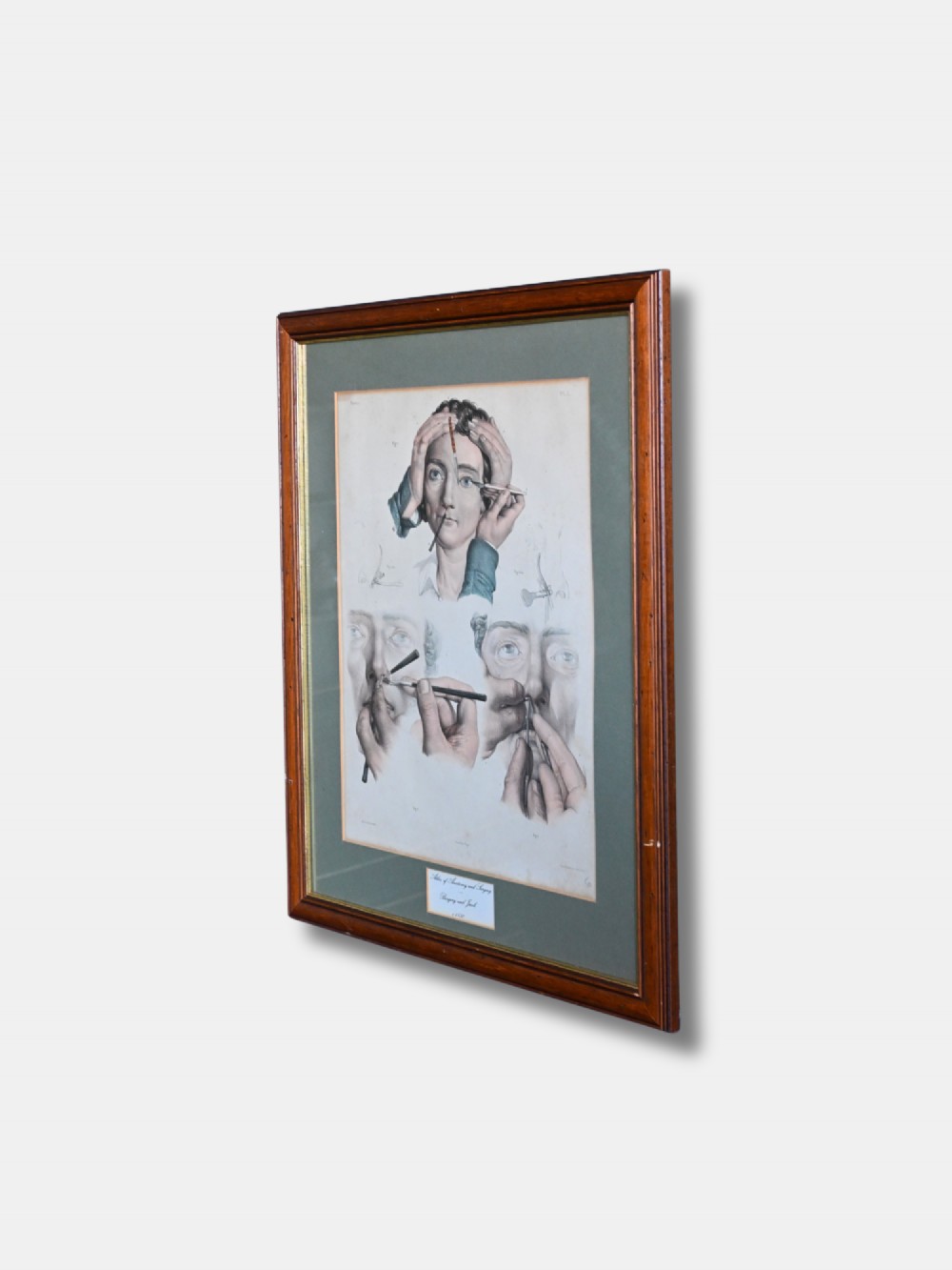 A framed 19th-century hand-coloured lithograph displaying three detailed surgical procedures on the human face, presented within a sage green mount and a warm brown wood frame. View II