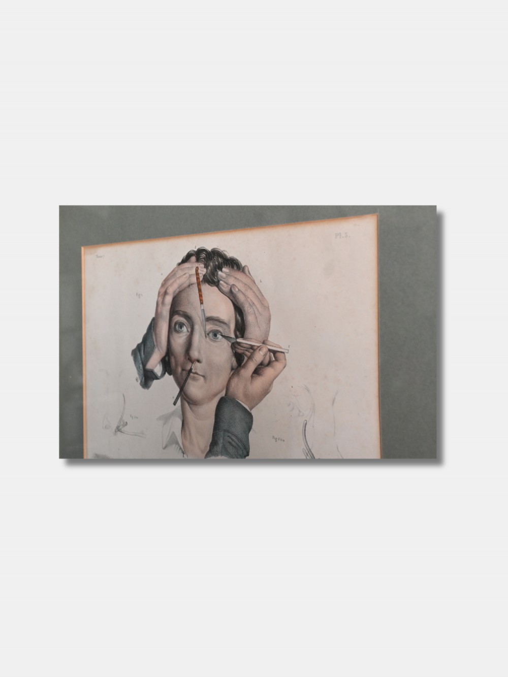 A framed 19th-century hand-coloured lithograph displaying three detailed surgical procedures on the human face, presented within a sage green mount and a warm brown wood frame. View III
